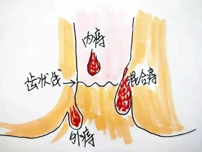 長痔瘡有肉球腫脹怎么辦？全面解析應(yīng)對方法，長痔瘡引發(fā)肉球腫脹如何應(yīng)對？全面解析治療與緩解方法