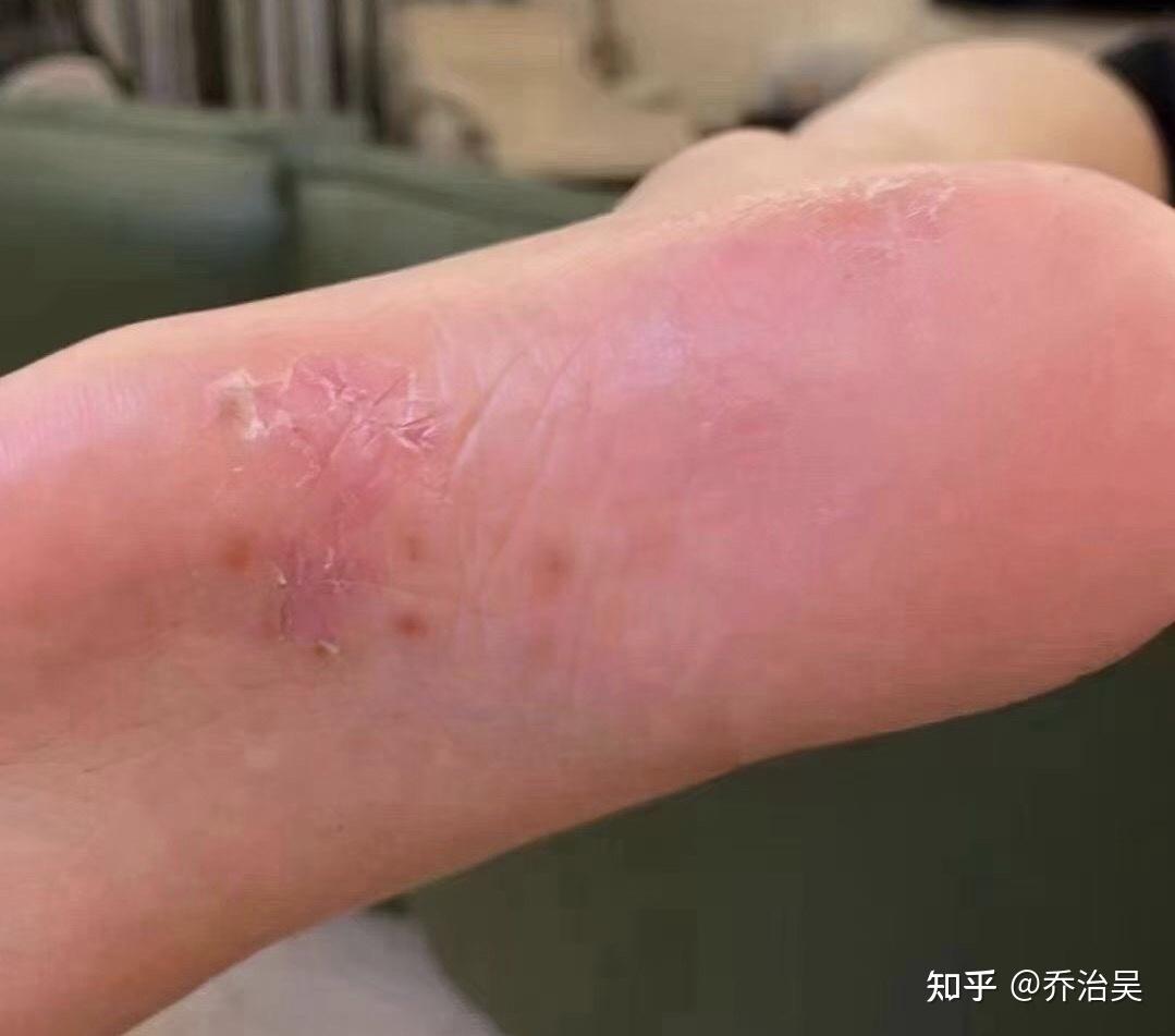 水泡型腳氣怎么根治，全面解析有效方法，全面解析，根治水泡型腳氣有效方法
