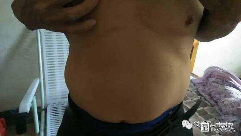 肝有腹水是否已到晚期，深入解析與應(yīng)對(duì)策略，深入解析，肝腹水是否意味著病情晚期及應(yīng)對(duì)策略探討