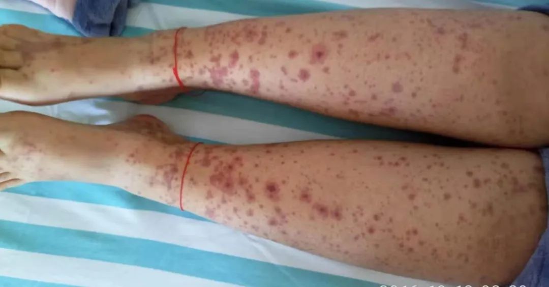 過敏性紫癜是終身病嗎？解析與理解，過敏性紫癜解析，是否為終身疾病？