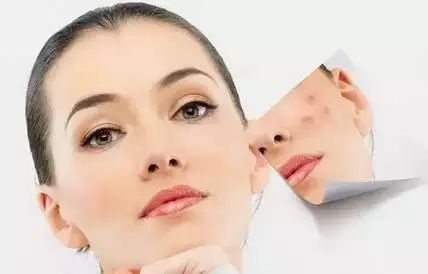 如何有效去痘痘痘印，改善皮膚狀態(tài)——全方位指南，全方位指南，去痘痘痘印，改善皮膚狀態(tài)的有效方法