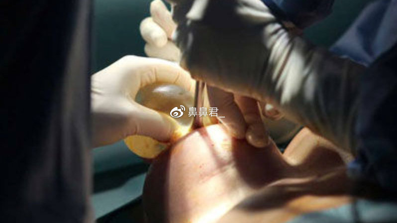 隆胸假體取出親身經(jīng)歷分享，我的手術(shù)經(jīng)歷與恢復(fù)過(guò)程，隆胸假體取出手術(shù)經(jīng)歷分享，我的恢復(fù)之旅