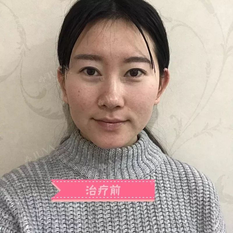 關(guān)于水光針停用后是否會(huì)變老的研究與解析，水光針停用后的肌膚老化研究與解析