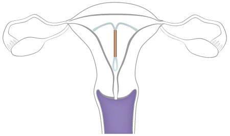 上環(huán)對身體有什么影響，全面解析與指導(dǎo)建議，全面解析與指導(dǎo)建議，上環(huán)對身體的影響及注意事項(xiàng)