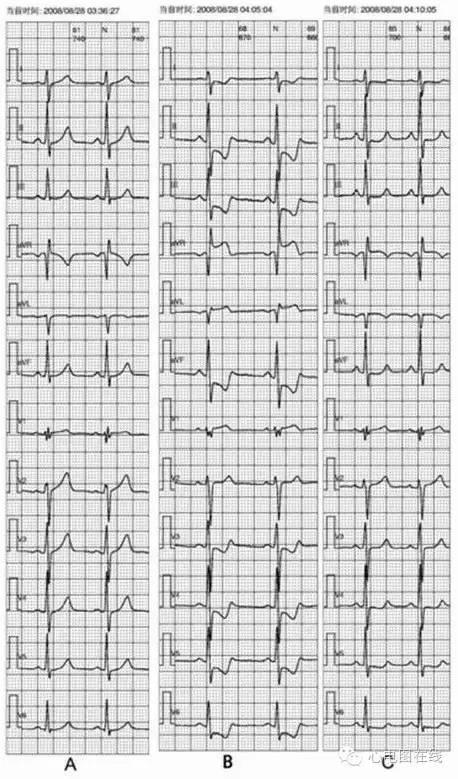 腦供血不足會自愈嗎？解析癥狀、原因及治療方法，腦供血不足詳解，癥狀、成因與治療方法，能否自愈？