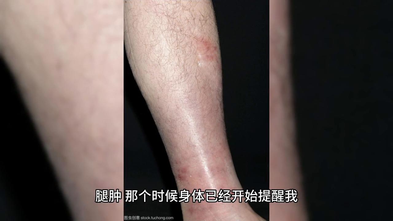 尿酸水平與尿毒癥，深入了解尿酸達(dá)到多少可能引發(fā)尿毒癥，尿酸水平與尿毒癥風(fēng)險，尿酸超標(biāo)可能引發(fā)尿毒癥深度解析