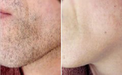 臉部脫毛需要多少錢，全面解析費(fèi)用因素與選擇建議，臉部脫毛費(fèi)用詳解，全面解析費(fèi)用因素與選擇建議