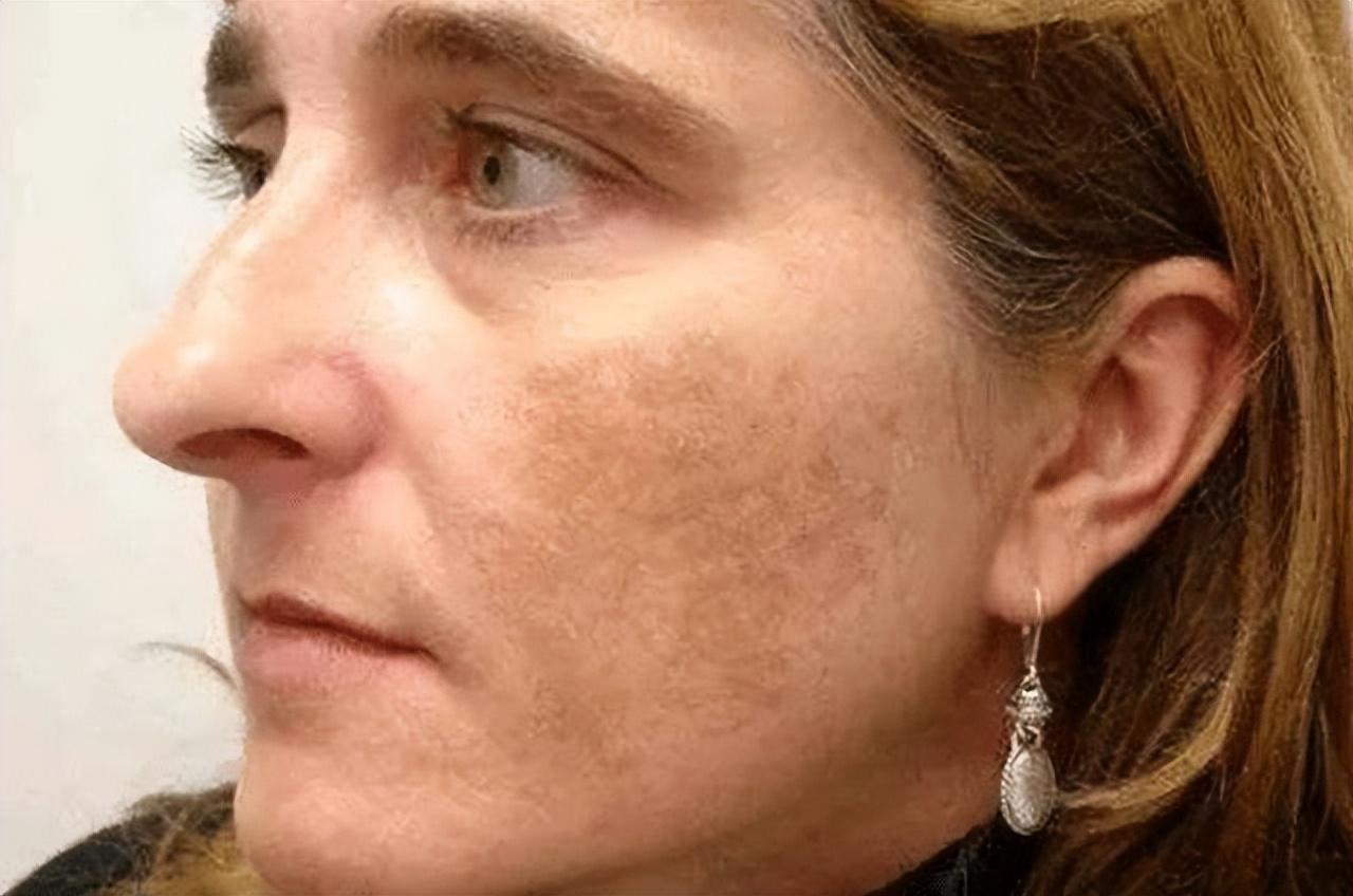 如何有效去除老年斑——全方位指南，全方位指南，如何有效去除老年斑