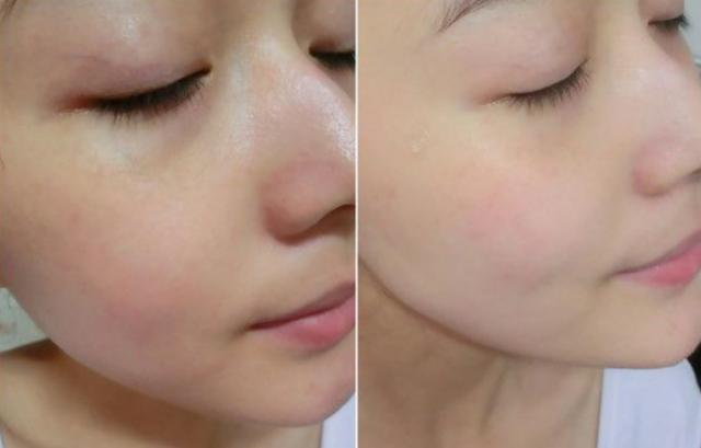 如何解決臉上出油太多的問題，解決臉部出油過多的方法技巧