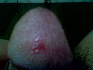 紅霉素軟膏涂龜頭后果分析，紅霉素軟膏涂龜頭的后果解析