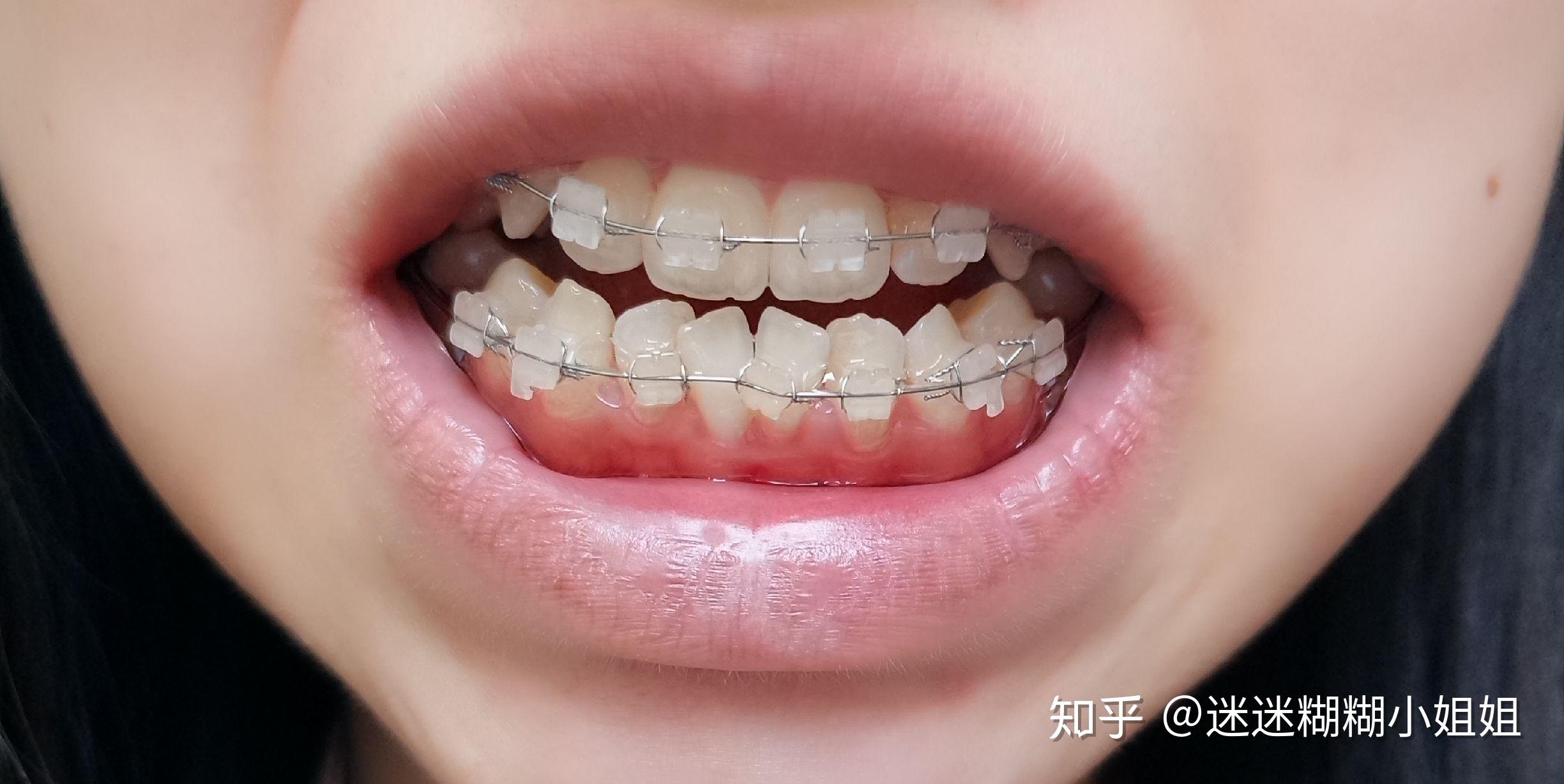 矯正牙齒的黃金時(shí)期與成年后的選擇，探討36歲矯正牙齒的必要性，矯正牙齒的黃金時(shí)期與成年后的選擇，探討矯正牙齒的必要性至36歲