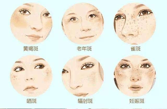 黃褐斑早期圖片，識(shí)別、預(yù)防與應(yīng)對(duì)，黃褐斑早期識(shí)別、預(yù)防與應(yīng)對(duì)策略及圖片解析