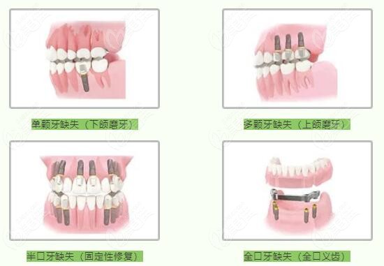 種牙多少錢一顆牙價(jià)格表2023，全面解析種植牙費(fèi)用及影響因素，2023年種植牙價(jià)格表全面解析，費(fèi)用、影響因素一網(wǎng)打盡