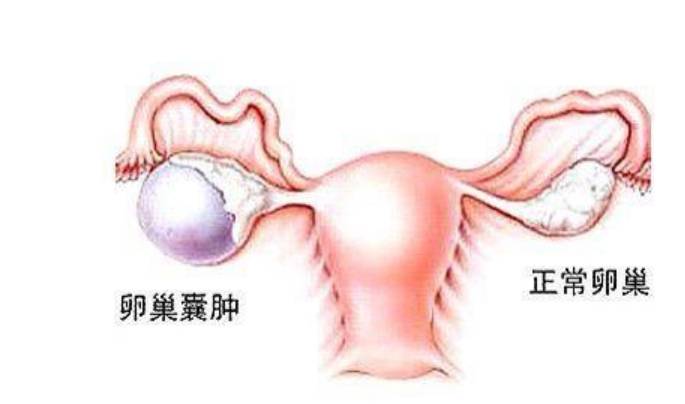 卵巢囊腫的癥狀及應(yīng)對(duì)方法，卵巢囊腫的癥狀與應(yīng)對(duì)之策