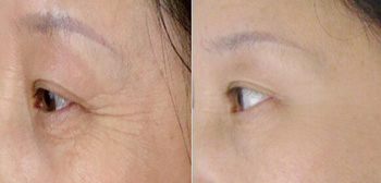 打除皺針一般價(jià)格解析，因素、市場(chǎng)行情及預(yù)算考量，打除皺針的價(jià)格解析，市場(chǎng)行情、影響因素與預(yù)算考量全知道