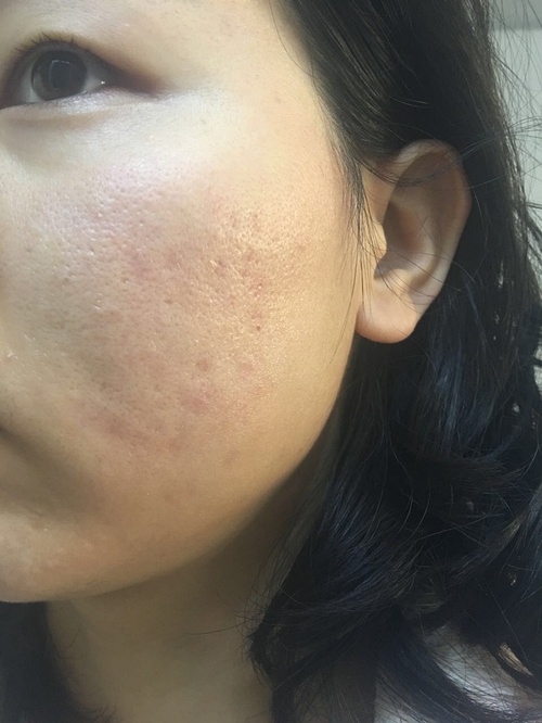 嚴(yán)重痤瘡治療最徹底的方法，全面攻略與最佳實(shí)踐，全面攻略揭秘，最徹底治療嚴(yán)重痤瘡的最佳實(shí)踐與最佳方法