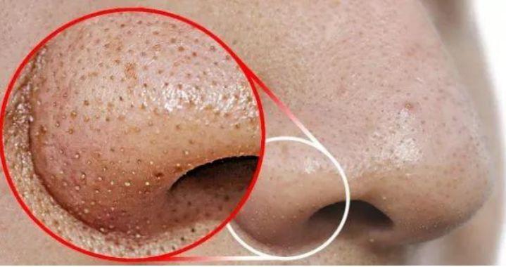 孩子身上起螨蟲(chóng)疙瘩圖片，了解、預(yù)防與治療，孩子身上的螨蟲(chóng)疙瘩，圖片、預(yù)防與治療全攻略