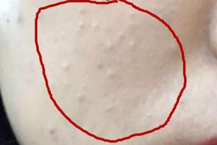 粉刺長(zhǎng)什么樣子？圖片解析帶你深入了解，粉刺詳解，圖片解析帶你探索其真實(shí)面貌