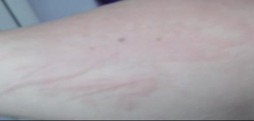 急性過(guò)敏性蕁麻疹，全面解析與應(yīng)對(duì)策略，急性過(guò)敏性蕁麻疹，全面解析及應(yīng)對(duì)指南