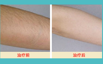 激光脫毛的價格解析，多少錢才能擁有絲滑肌膚？，激光脫毛價格詳解，多少錢能擁有絲滑肌膚？