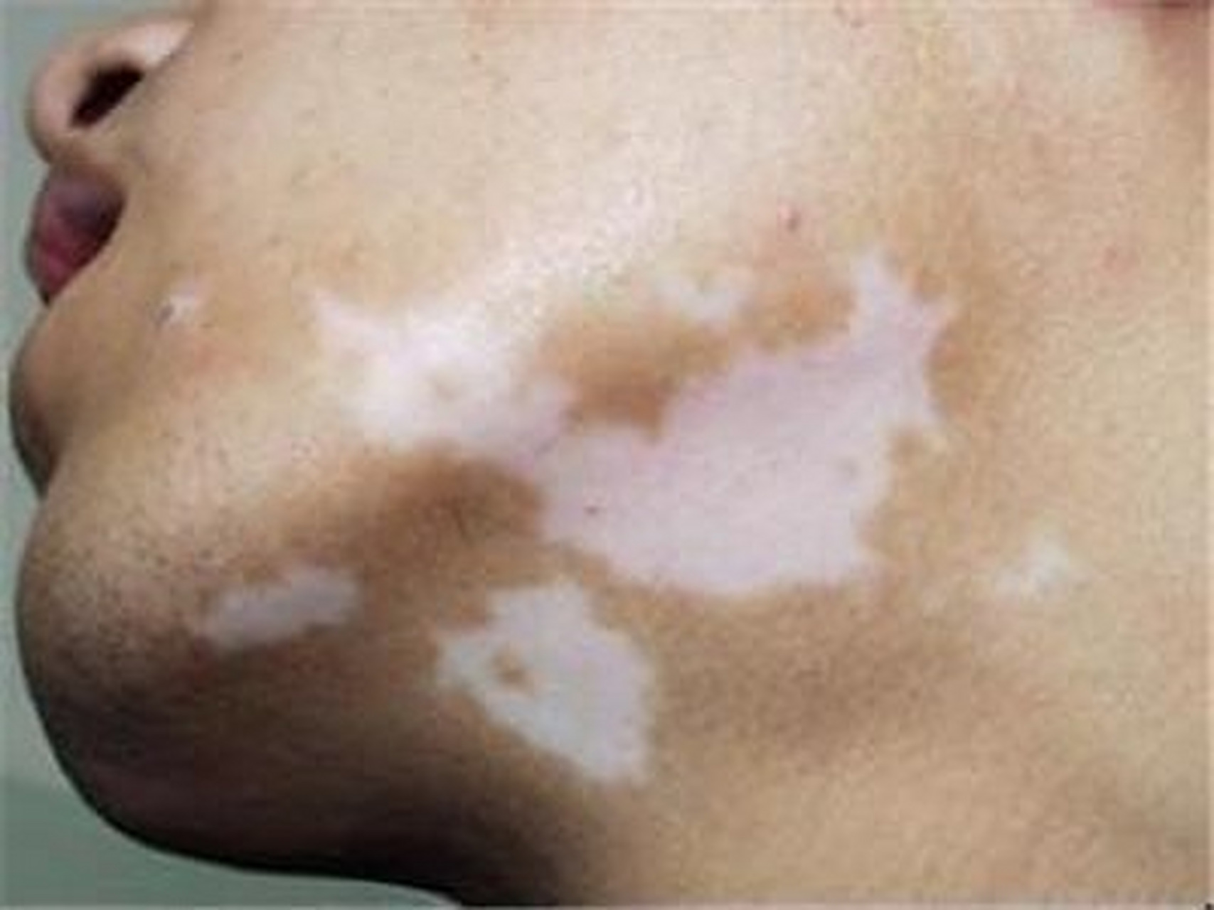 白點(diǎn)癲風(fēng)怎么治療效果最好，全面解析最佳治療方案，全面解析白點(diǎn)癲風(fēng)最佳治療方案，治療效果最大化