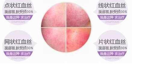 淡化紅血絲的小竅門，實(shí)用方法與日常護(hù)理建議，淡化紅血絲的小妙招，實(shí)用方法與日常護(hù)理建議