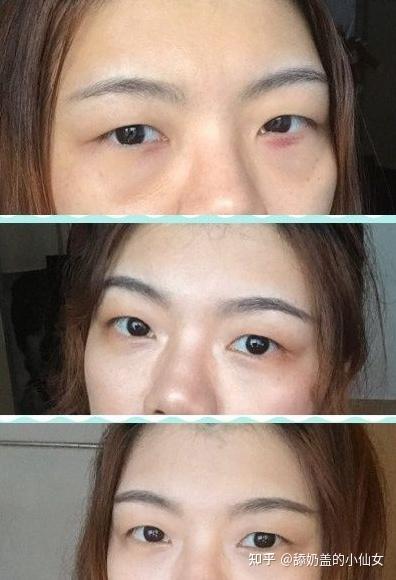 醫(yī)美去眼袋，價(jià)格因素與選擇策略，醫(yī)美去眼袋，價(jià)格因素詳解與選擇策略指南