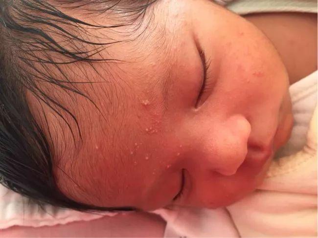 脂溢性皮炎的治療方法，全面解析最佳策略，脂溢性皮炎全面解析最佳治療方法策略