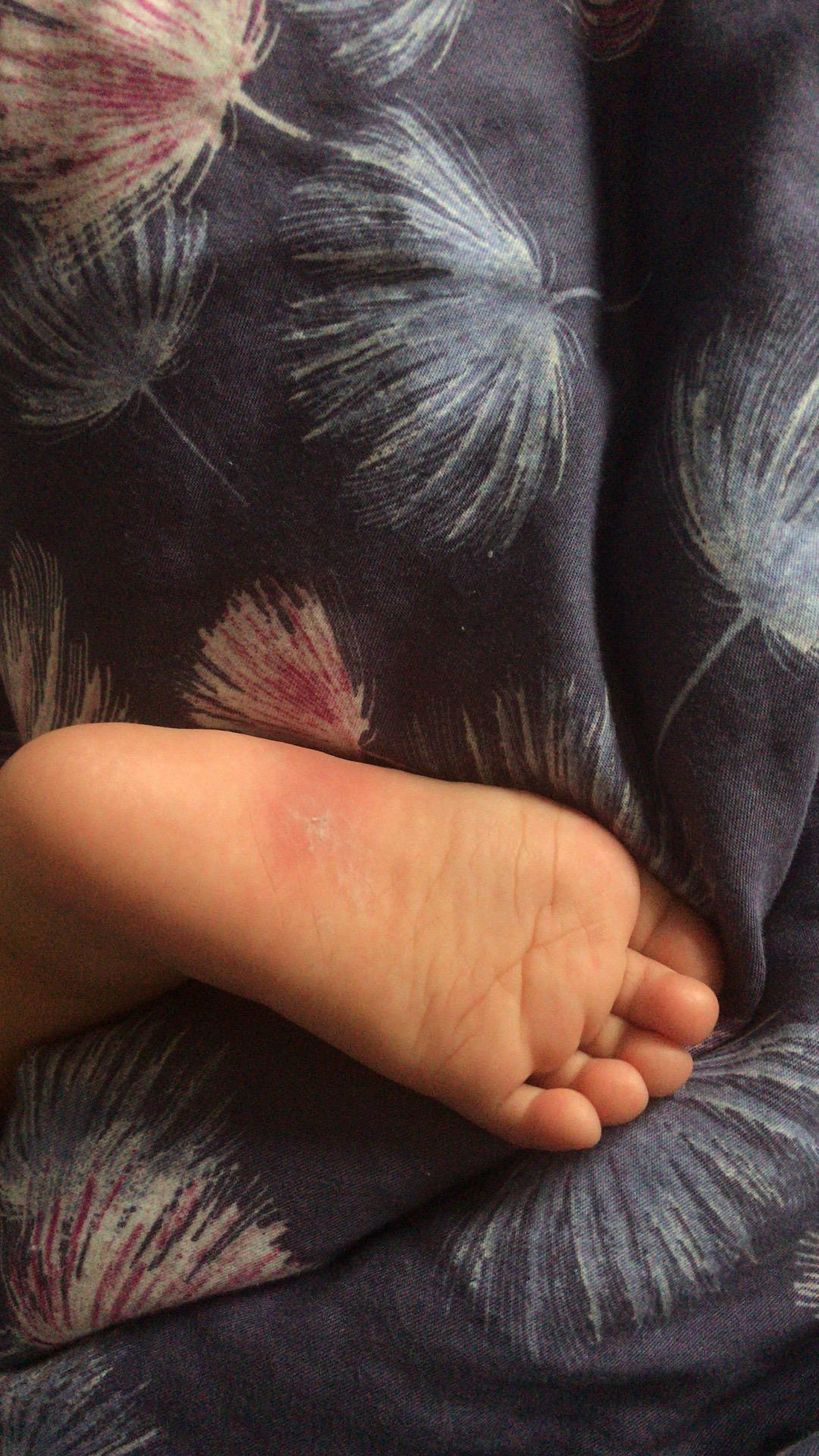 揭秘蚊子喜歡咬的八類人，揭秘蚊子偏愛(ài)的八類人群